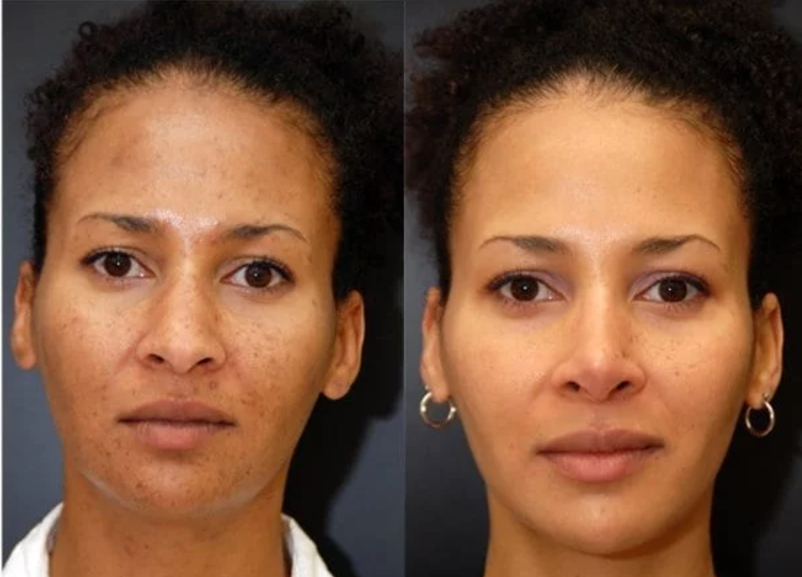 SculptVisage Pro™ - Obtenez une peau parfaitement rajeunie et éclatante en 2 semaines ✨