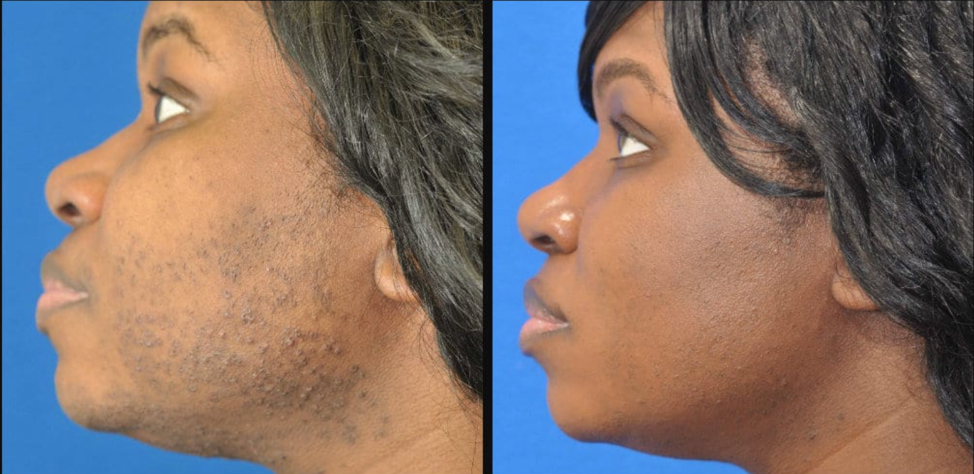 SculptVisage Pro™ - Obtenez une peau parfaitement rajeunie et éclatante en 2 semaines ✨