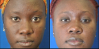 SculptVisage Pro™ - Obtenez une peau parfaitement rajeunie et éclatante en 2 semaines ✨